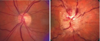 image of normal optic nerve and a swollen optic nerve