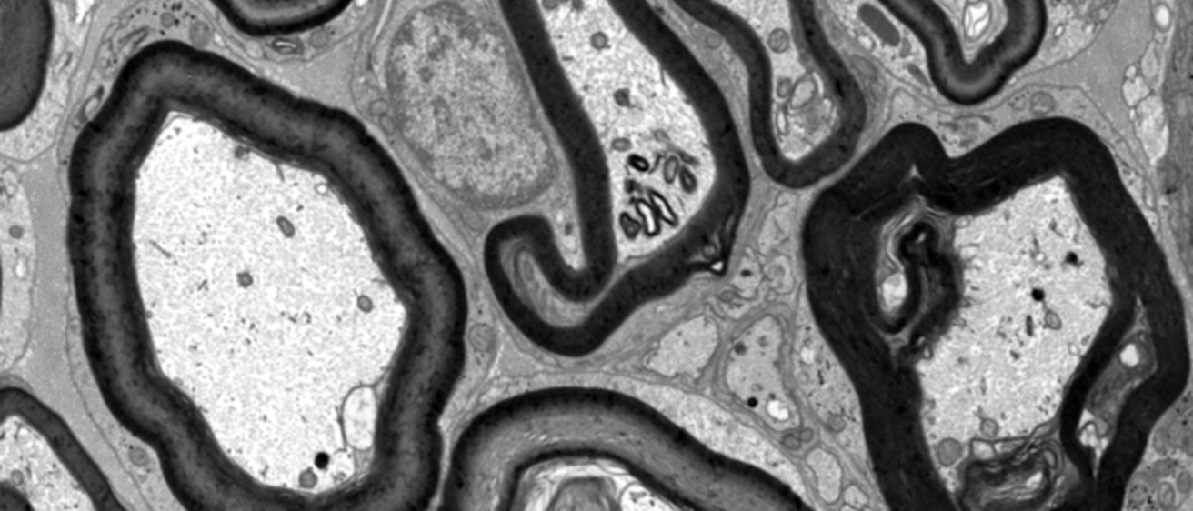 Image shows electron microscopy of myelin abnormalities caused by CF mutation