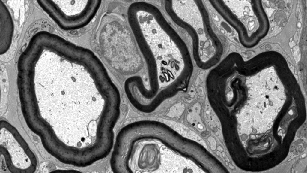 Image shows electron microscopy of myelin abnormalities caused by CF mutation