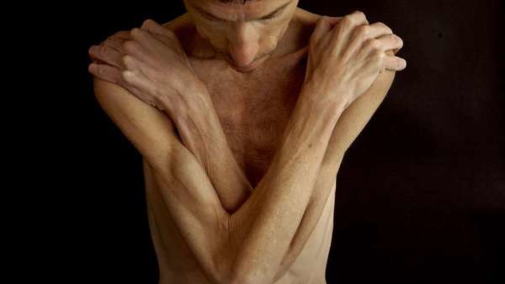 Photo of a male anorexic clutching his chest with his arms. Photo courtesy of the LA Times
