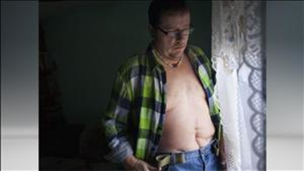 Photo of a male patient who has extensive scars on his stomach from a surgical item being left in his body, Photo: Grant T. Morris for USA TODAY