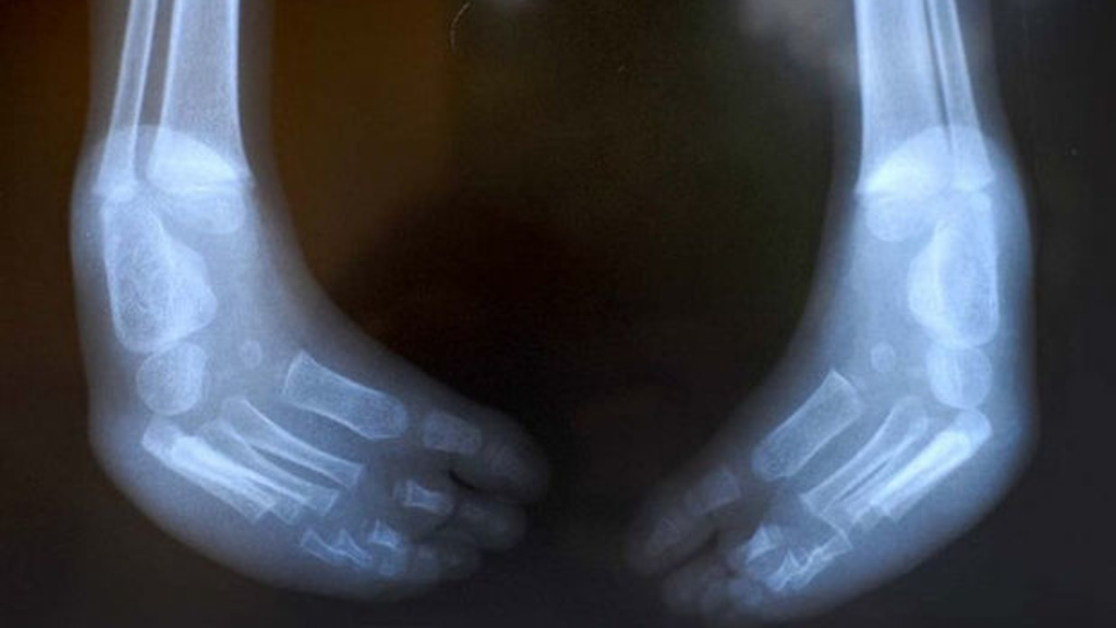 x-ray of deformed feet