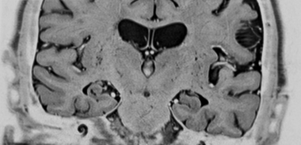 alzheimer brain scan