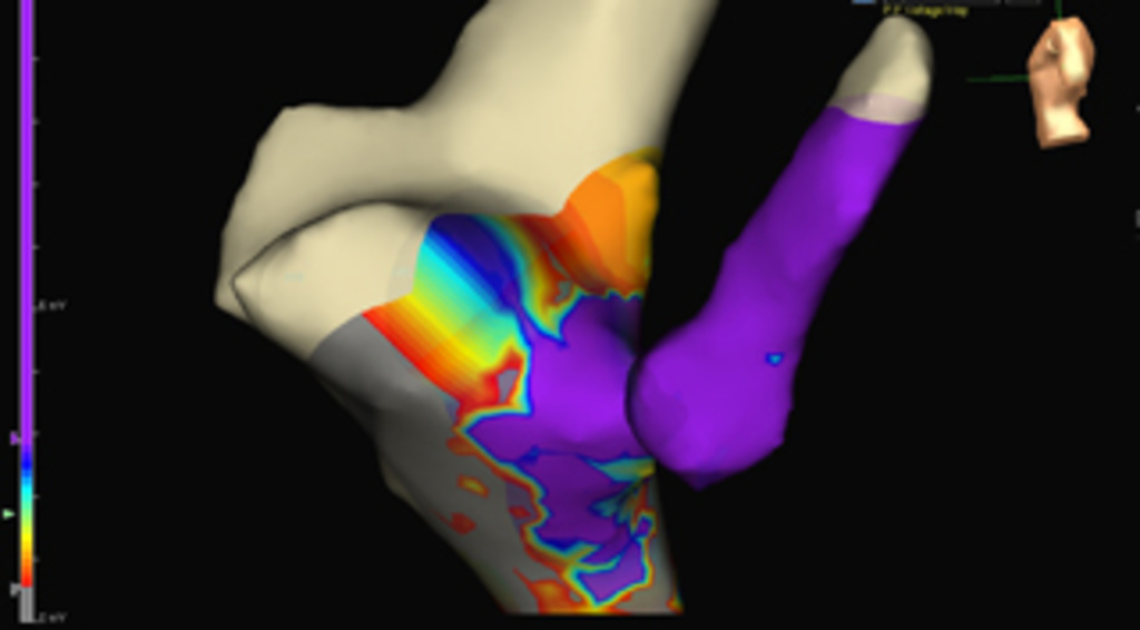 A new heart 'map' for child patients | Iowa Now - The University of Iowa