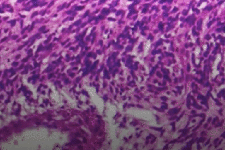 sarcoma image
