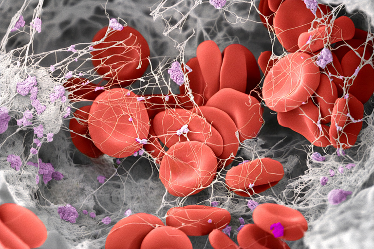 Colored scanning electronic microscope image of a human blood clot