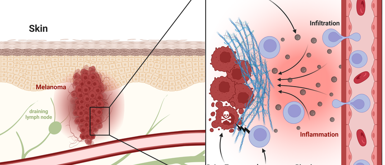 a graphic showing skin with a tumor (melanoma) and other components such as blood and lymphatic vessels; the magnified portion of the graph shows how nanoparticles attract stimulated immune cells to the tumor site (tumor microenvironment)