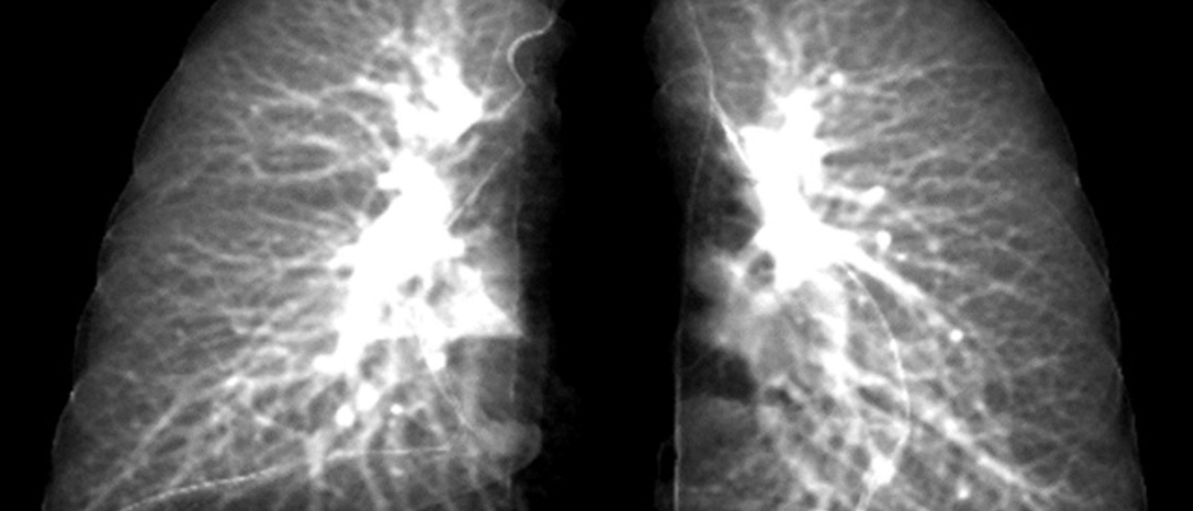 post-COVID-lung-story-photo.jpg