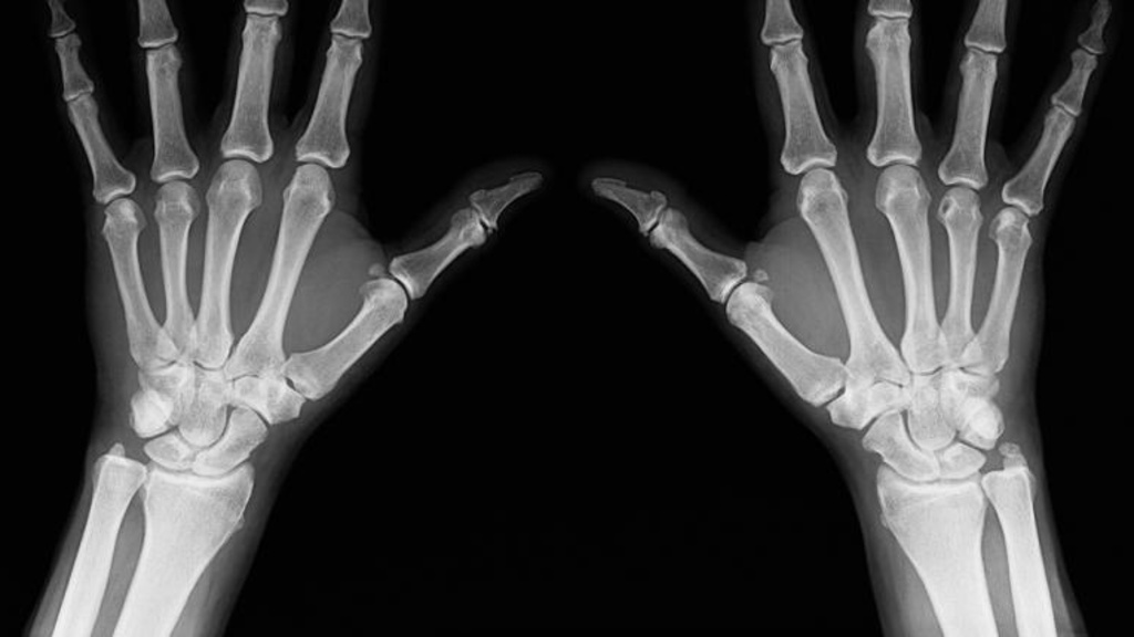 x-ray of hands