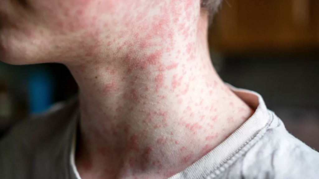 A person with measles rash on their neck